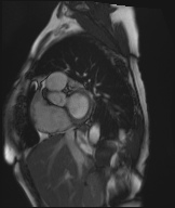 Cardiac amyloidosis (Radiopaedia 51404-57150 Sagittal CINE SSFP 262).jpg