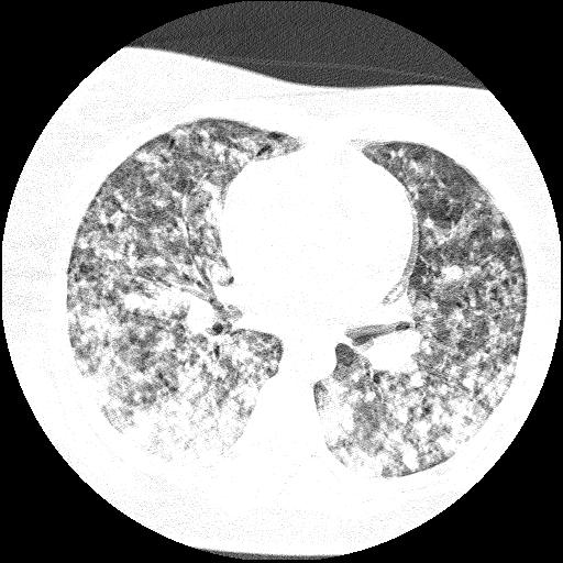 Cardiac angiosarcoma (Radiopaedia 66010-75181 Axial lung window 47).jpg