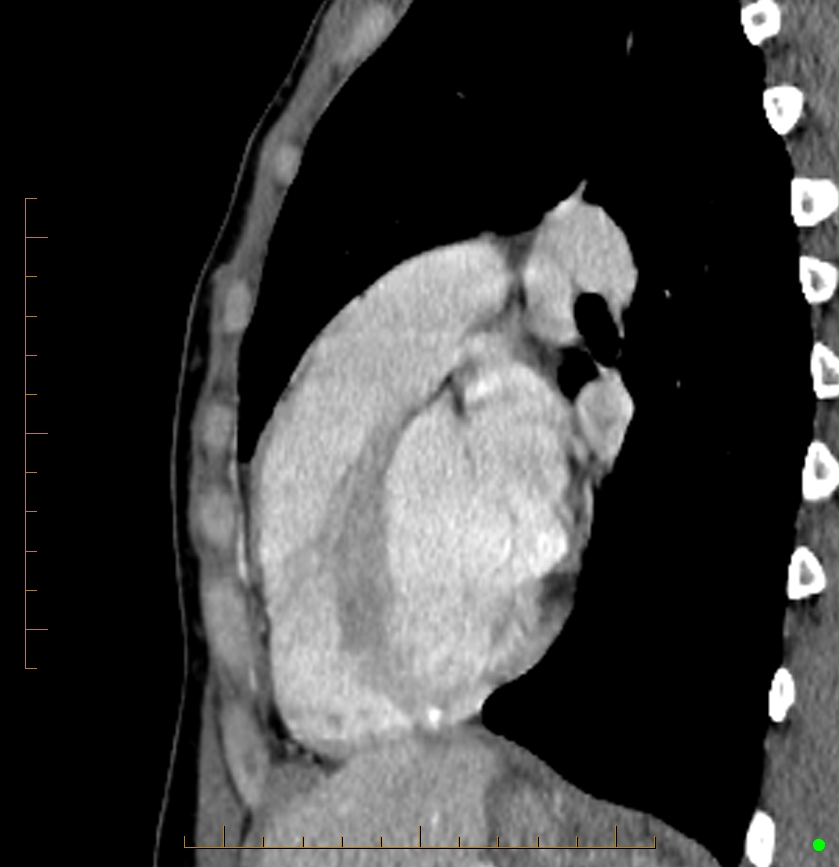Cardiac paraganglioma (Radiopaedia 76345-88005 C 36).jpg