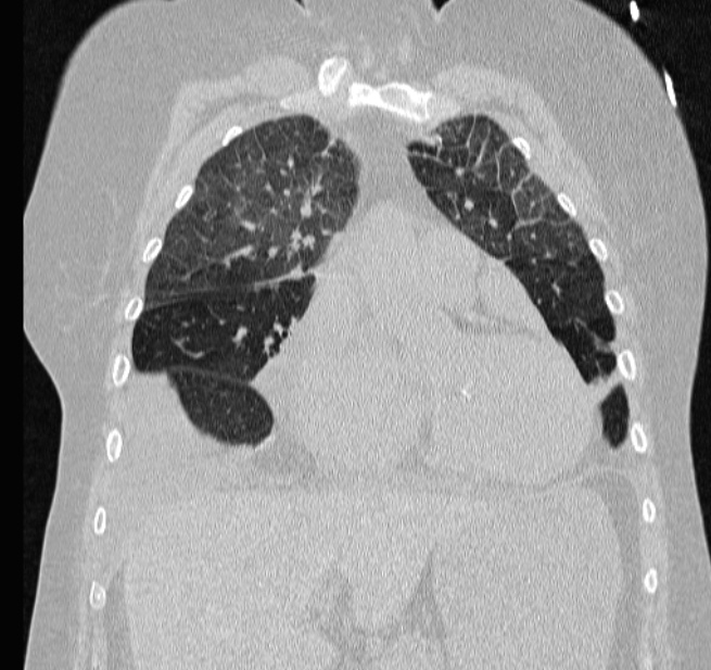 Cardiogenic pulmonary edema (Radiopaedia 29213-29609 Coronal lung window 22).jpg