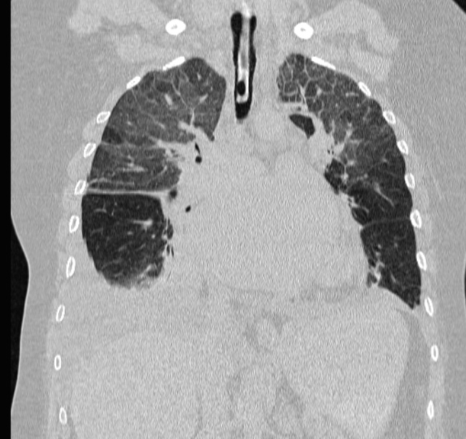 Cardiogenic pulmonary edema (Radiopaedia 29213-29609 Coronal lung window 33).jpg