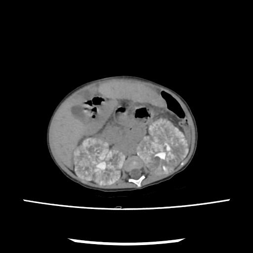 Caroli disease with autosomal recessive polycystic kidney disease (ARPKD) (Radiopaedia 89651-106703 E 102).jpg