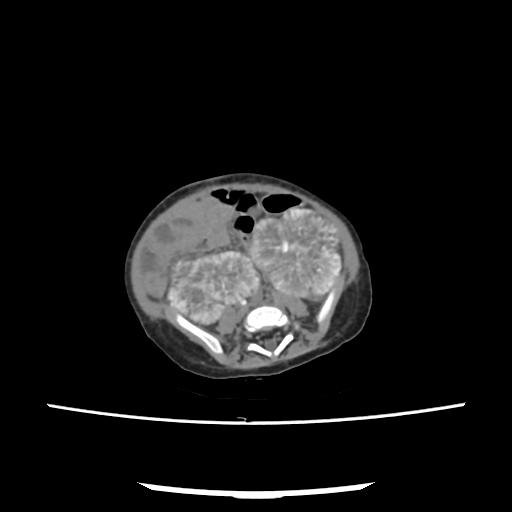 Caroli disease with autosomal recessive polycystic kidney disease (ARPKD) (Radiopaedia 89651-106703 E 169).jpg