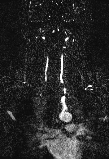 Carotid artery dissection (Radiopaedia 28441-28689 Coronal MRA 62).jpg