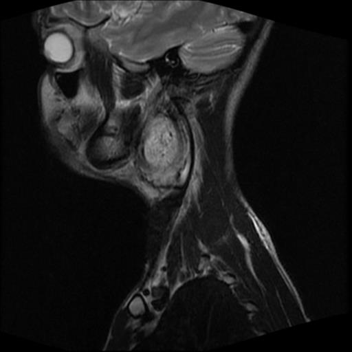 File:Carotid body tumor (Radiopaedia 30208-30823 Sagittal T2 16).jpg