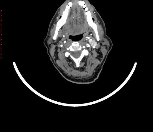 Carotid body tumor (Radiopaedia 66785-76116 B 15).jpg