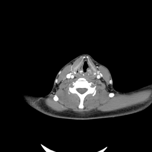 File:Carotid bulb pseudoaneurysm (Radiopaedia 57670-64616 A 48).jpg