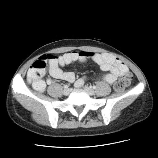 Castleman disease with fibrous pseudotumor in the abdomen (Radiopaedia 77296-89373 A 86).jpg