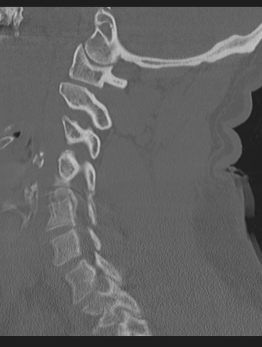 Cavernoma of cervical cord (Radiopaedia 50838-56346 Sagittal bone window 51).png
