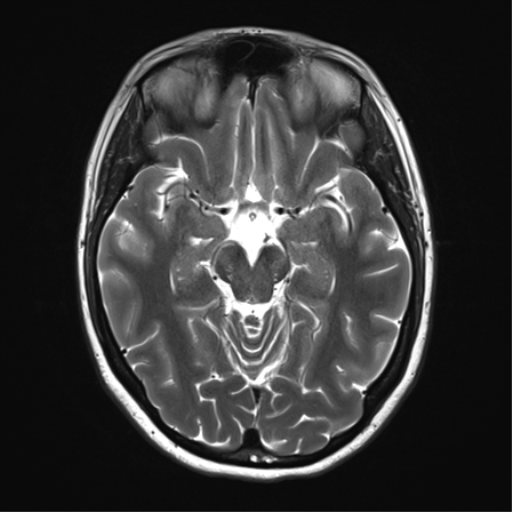 File:Cavernoma with bleed - midbrain (Radiopaedia 54546-60773 Axial T2 16).png