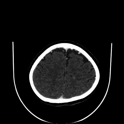 Cavernoma with developmental venous anomaly (Radiopaedia 22470-22506 C 158).jpg