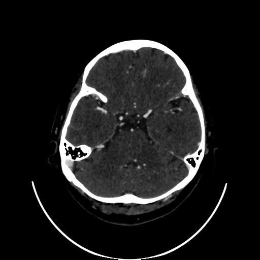 Cavernoma with developmental venous anomaly (Radiopaedia 22470-22506 C 44).jpg