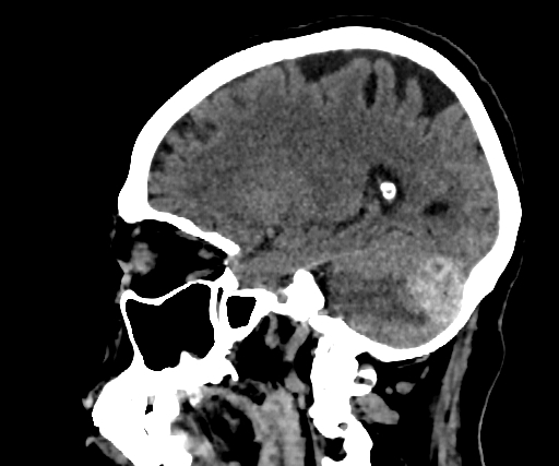 Cavernous hemangioma of the cerebellar falx (Radiopaedia 73025-83723 B 117).jpg