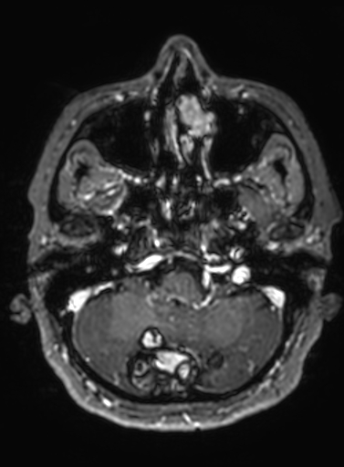 Cavernous hemangioma of the cerebellar falx (Radiopaedia 73025-83724 Axial T1 C+ 272).jpg