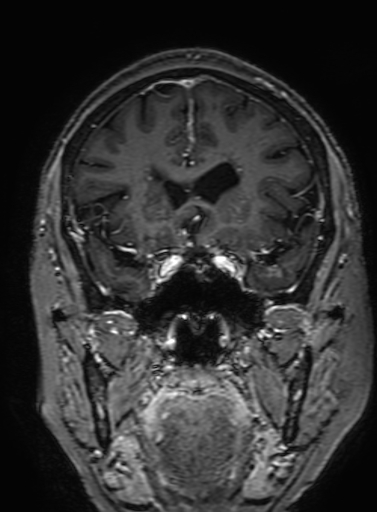 Cavernous hemangioma of the cerebellar falx (Radiopaedia 73025-83724 Coronal T1 C+ 130).jpg
