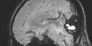 Cavernous hemangioma of the cerebellar falx (Radiopaedia 73025-83724 Sagittal BOLD 107).jpg