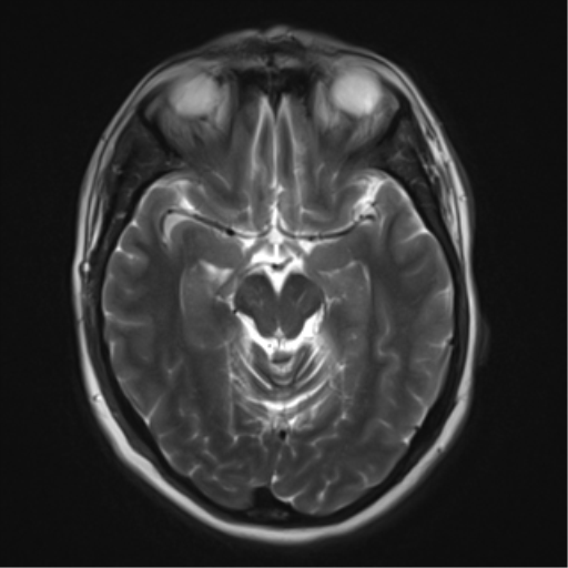 File:Cavernous malformation (cavernous angioma or cavernoma) (Radiopaedia 36675-38237 Axial T2 8).png