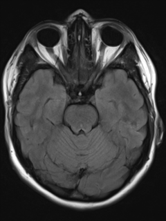 File:Cavernous malformation (cavernous angioma or cavernoma) (Radiopaedia 36675-38237 Axial T2 FLAIR 7).png