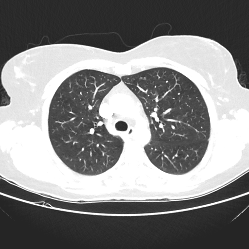 File:Cavitating lung mass - squamous cell carcinoma (Radiopaedia 48047-52854 Axial lung window 18).png