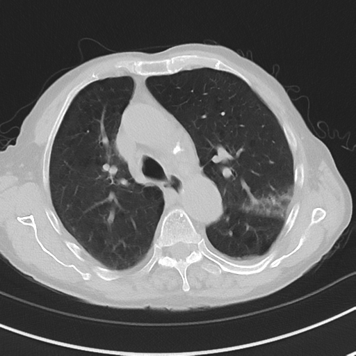 Cavitating pneumonia - lingular segments (Radiopaedia 34386-35678 Axial lung window 23).png