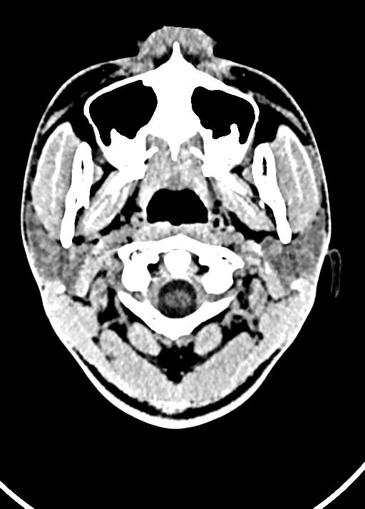 Cavum septum pellucidum and cavum vergae (Radiopaedia 77797-90060 Axial Brain Window 1).jpg