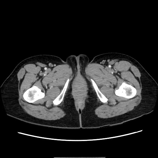 Cecal adenocarcinoma (Radiopaedia 75909-87331 A 94).jpg