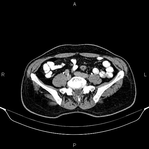 Cecal adenocarcinoma (Radiopaedia 85324-100916 Axial C+ delayed 67).jpg