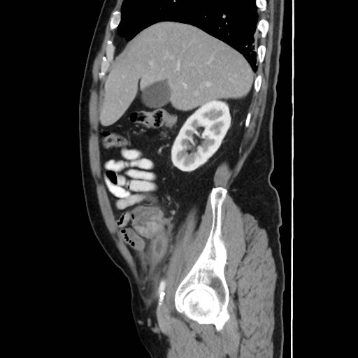 Cecal mass causing appendicitis (Radiopaedia 59207-66531 C 17).jpg