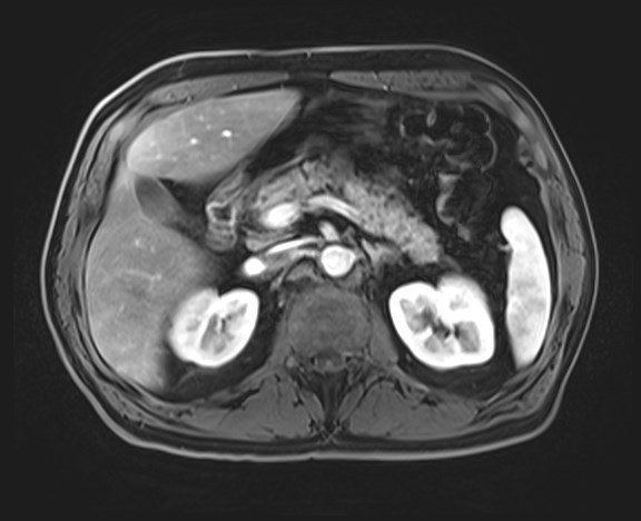 Cecal mass causing appendicitis (Radiopaedia 59207-66532 H 50).jpg