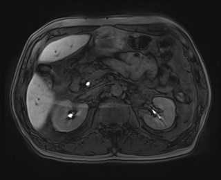 Cecal mass causing appendicitis (Radiopaedia 59207-66532 K 51).jpg