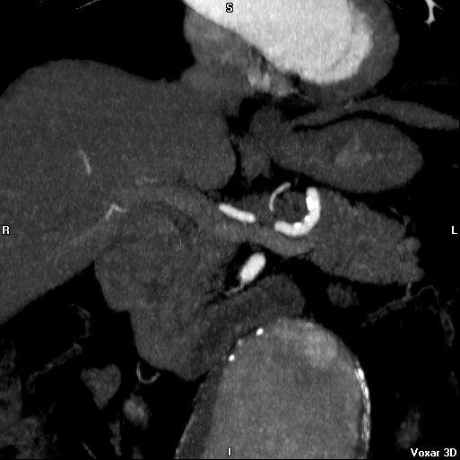 File:Celiac artery anatomy (Radiopaedia 16763-16476 A 8).jpg