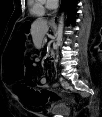 File:Celiac artery compression syndrome (Radiopaedia 24287-24570 A 6).jpg