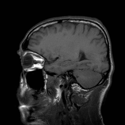 File:Central-variant posterior reversible encephalopathy syndrome (PRES) (Radiopaedia 43880-47358 Sagittal T1 17).jpg
