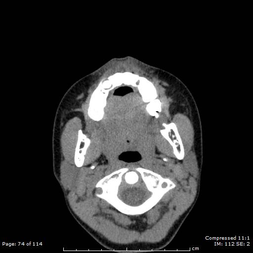 Central giant cell granuloma (Radiopaedia 45612-49754 Axial non-contrast 37).jpg