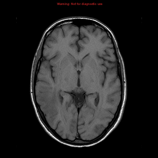 File:Central nervous system vasculitis (Radiopaedia 8410-9235 Axial T1 12).jpg