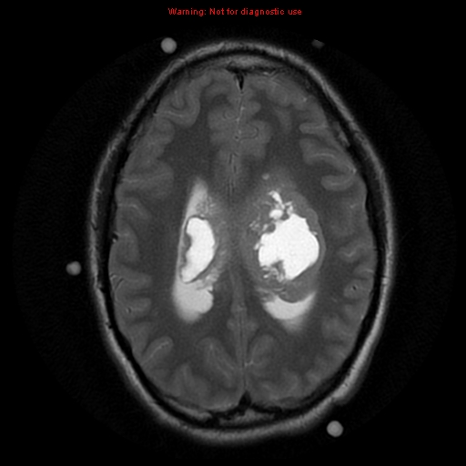 File:Central neurocytoma (Radiopaedia 13188-13206 Axial T2 6).jpg