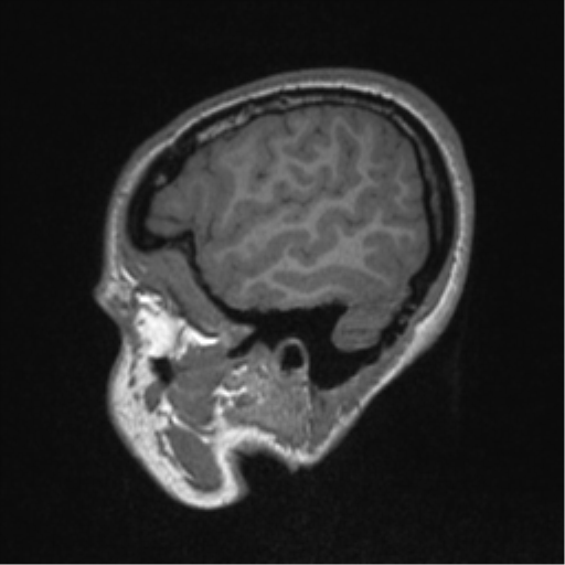 Central neurocytoma (Radiopaedia 37664-39557 Sagittal T1 17).png