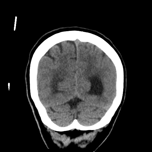 File:Central neurocytoma (Radiopaedia 65317-74346 Coronal non-contrast 49).png