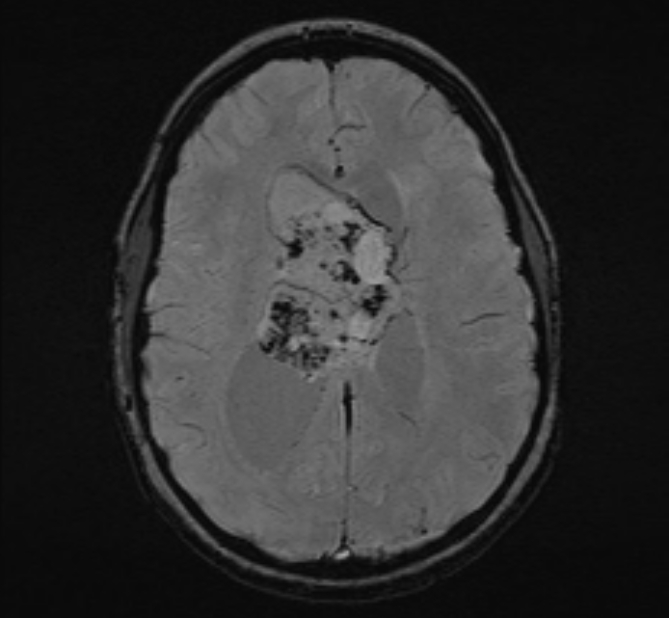Central neurocytoma (Radiopaedia 70263-80336 Axial SWI 36).jpg