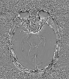 Central neurocytoma (Radiopaedia 84497-99872 Axial 28).jpg