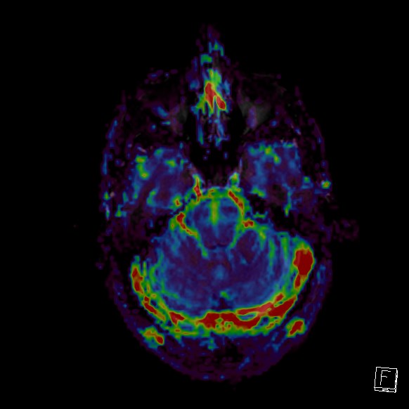 Central neurocytoma (Radiopaedia 84497-99872 Axial Perfusion 238).jpg