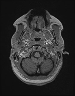 Central neurocytoma (Radiopaedia 84497-99872 Axial T1 30).jpg