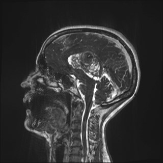 Central neurocytoma (Radiopaedia 84497-99872 Sagittal CISS 42).jpg