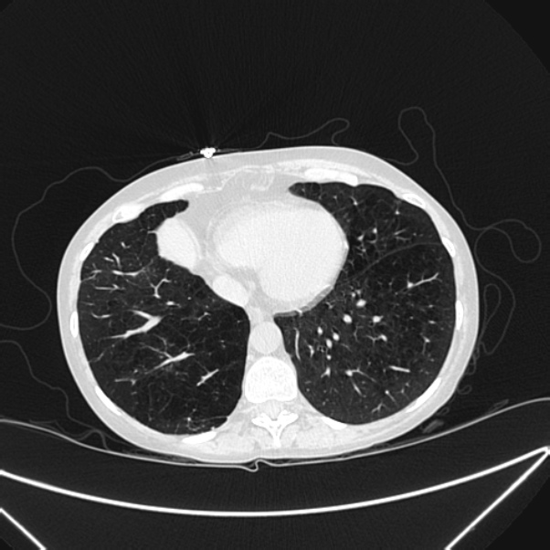 Centrilobular pulmonary emphysema (Radiopaedia 24495-24789 Axial lung window 71).jpg