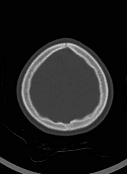 Cerebellar abscess (Radiopaedia 73727-84527 Axial bone window 57).jpg