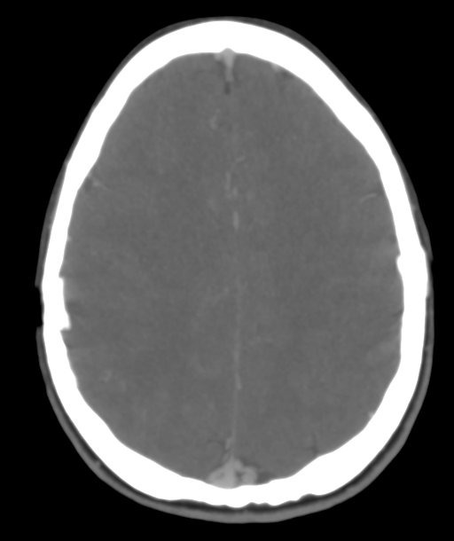 Cerebellar arteriovenous malformation- with hemorrhage (Radiopaedia 35752-37297 B 37).png