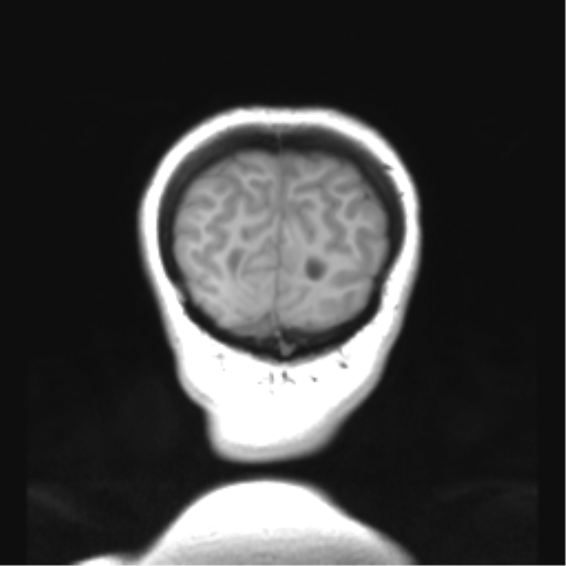 Cerebellar ependymoma complicated by post-operative subdural hematoma (Radiopaedia 83322-97736 Coronal T1 53).png
