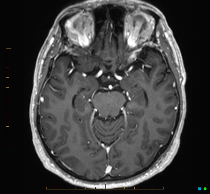 Cerebellar gangliocytoma (Radiopaedia 65377-74422 Axial T1 C+ 48).jpg