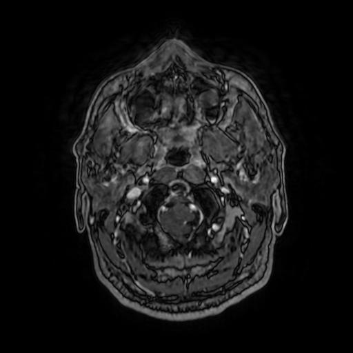Cerebellar hemangioblastoma (Radiopaedia 88055-104622 Axial T1 C+ 27).jpg