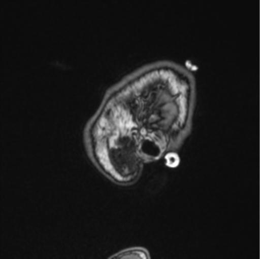 Cerebellar hemangioblastomas and pituitary adenoma (Radiopaedia 85490-101176 Sagittal T1 88).png